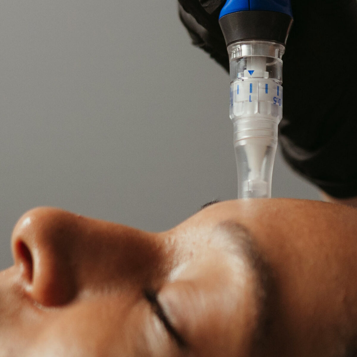 Woman getting SkinPen treatment