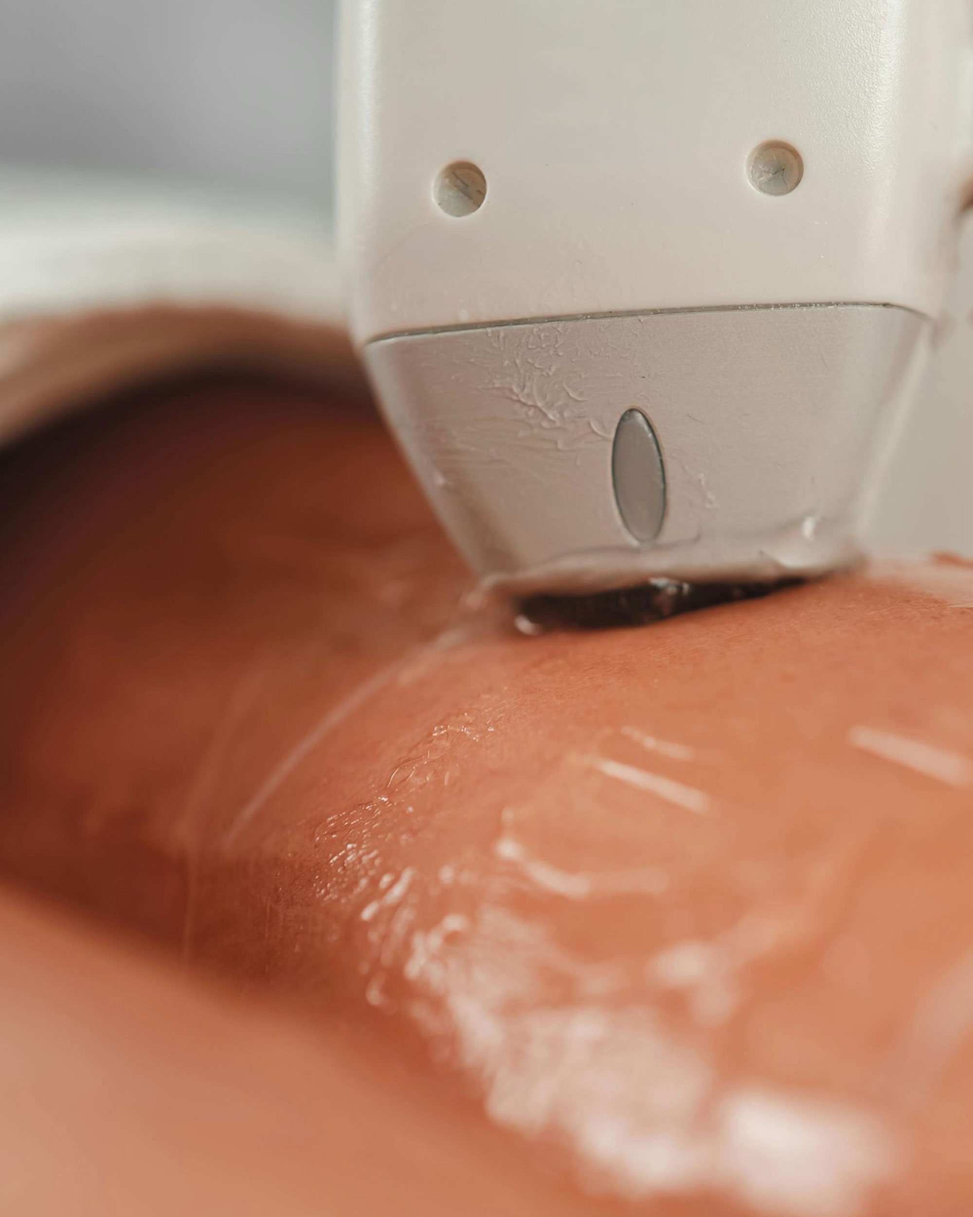 laser-hair-removal-2