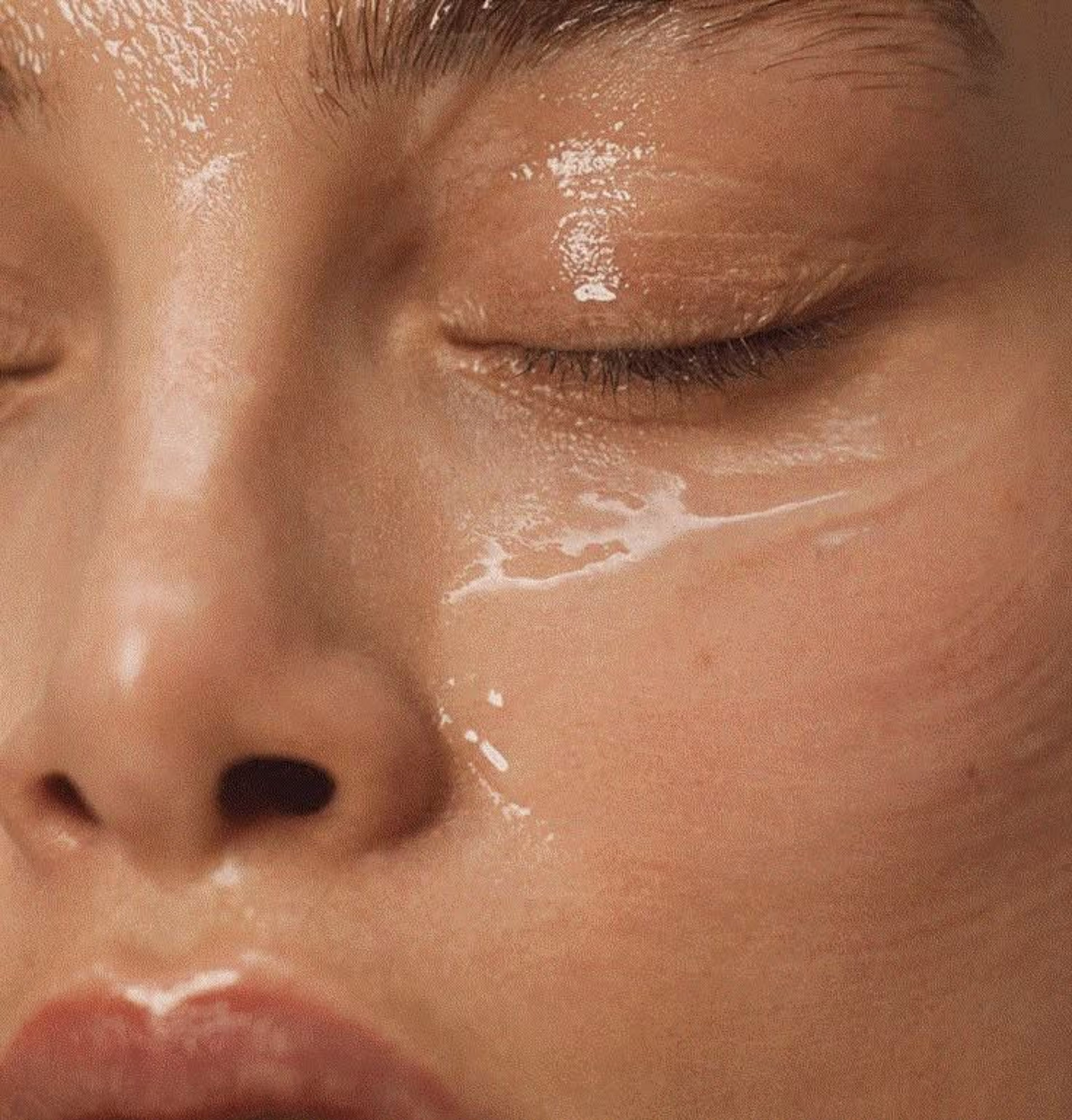 Woman with VI Peel